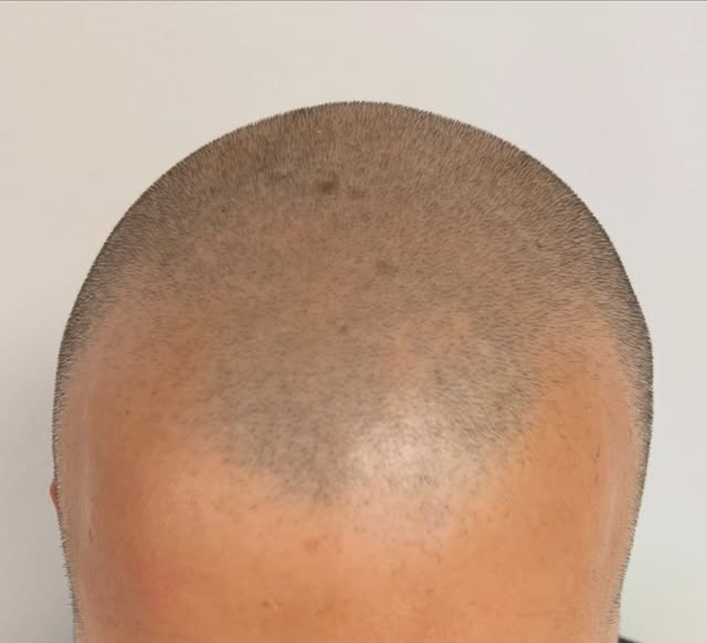 Swipe…👆
My client is thinning throughout so he likes to have his hair shaved short.  However,I have
