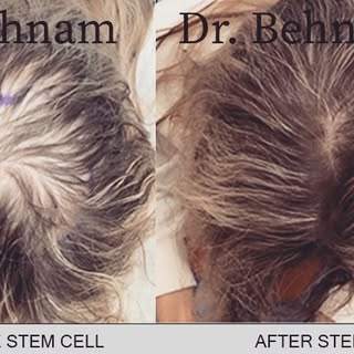 Before and after stem cell
#stemcell #hair