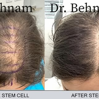 Before and after stem cell
#stemcell #hair