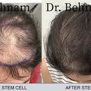 Before and after stem cell
#stemcell #hair