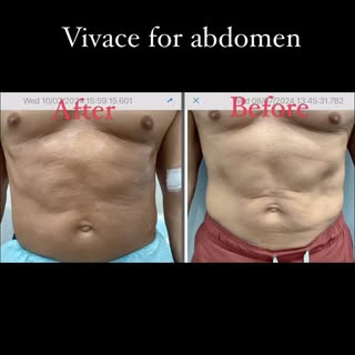 Vivace RF micro needling for abdominal creepiness #crepiness #abdominal #rfmicroneedling #morpheus