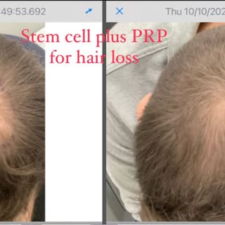 Stem cell plus PRP for hair loss. Results 9 months after 1 session only. Still going strong.

#StemC