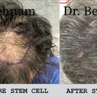 Stem cell plus prp for hair loss. Stem cells is a powerful way of gowin your hair back. What is stem