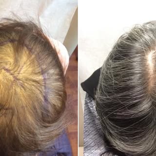 STEM CELL HAIR RESTORATION. 
.
.
.
#StemCellHairRestoration #PRPHairRestoration #HairLoss #HairRegro