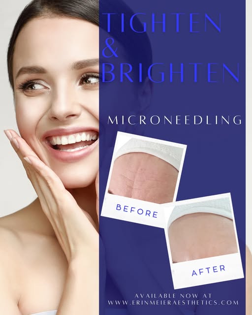 ✨ Tighten & Brighten with Microneedling ✨

Ready to hit reset on your skin? Microneedling stimulates