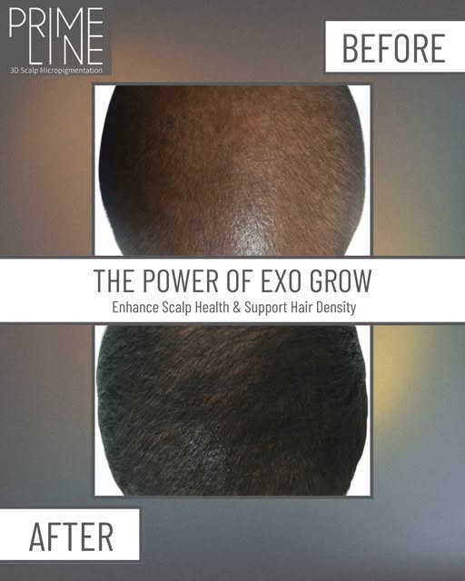 The ultimate power duo for hair restoration. 👤 @primelineokc

Incredible results from combining Sca