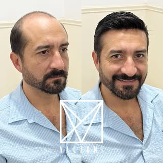 En Valzomi sabemos que el cabello es el marco del rostro…
Un poco de cabello hace una gran diferenci