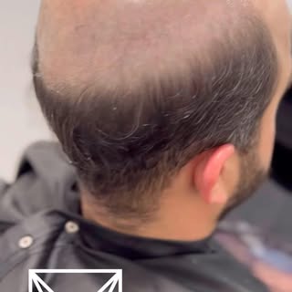 Nuestros Sistemas Capilares Premium hacen un perfecto empate con tu cabello, en color, textura, ondu