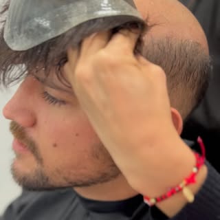 Nuestros sistemas capilares son una solución para la calvicie y nos dará un resultado inmediato.

Ag
