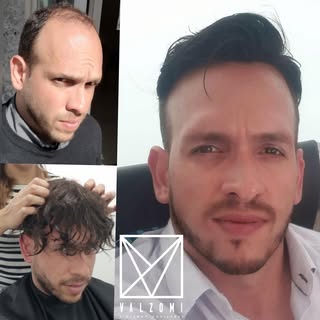 En Valzomi sabemos que has probado mil cosas para la caída del cabello, tales como shampoos mágicos 