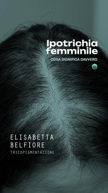 Il diradamento femminile è molto più diffuso di quanto si pensi.
Nel mio lavoro incontro molte donne