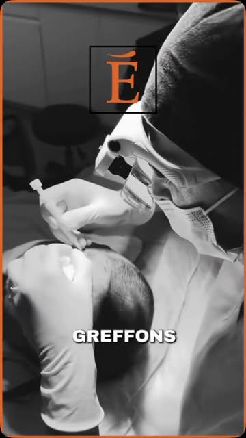 IMPLANTATION CHOÏ ✨

Une technique précise. Un résultat naturel. 🤍

Grâce à l’implantation directe 