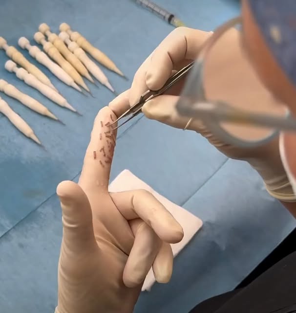 🔥LA PRÉCISION AU SERVICE DE LA GREFFE CAPILLAIRE

Chaque follicule compte. Chaque implantation méri