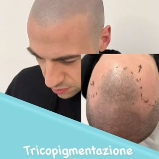 Le calvizie non saranno più un problema grazie alla Tricopigmentazione. Consulenza gratuita info wha
