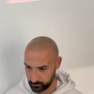 La caduta dei capelli non disturberà più il tuo aspetto estetico …. La tricopigmentazione ti aiuta a