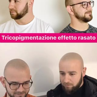 Addio alla calvizie con la tricopigmentazione effetto rasato risolvi il problema …