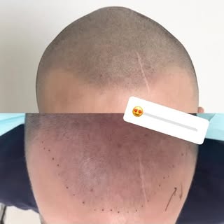 Tricopigmentazione conservativa, integrazione dei capelli eseguita in modo da ricostituire la forma 