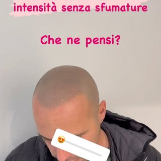 Tricopigmentazione ad alta intensità! Integrazione del capello rasato eseguita senza sfumature front
