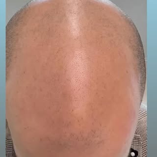 Tricopigmentazione effetto rasato! Ricostruzione totale delle zone front-mid-vertex. Whatsapp info 3