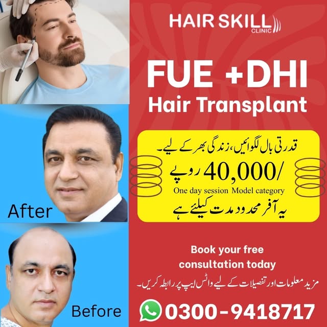 Natural hair for a lifetime! 
Transform your look with our FUE + DHI Hair Transplant for just Rs. 40