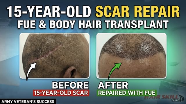 Witness the incredible transformation of army veteran Muhammad Akbar from Khushab. 

He visited Hair