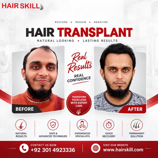 Restore your hair and regain your confidence with a permanent solution from Hair Skill Clinic.

 Exp