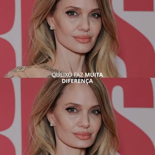 Ele participa da harmonia facial mais do que a gente imagina. Um queixo bem projetado ajuda a equili