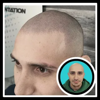 Let hair loss be a thing of the past!
⬇️ Call or text for a free consultation
📞 716-465-9955
✅ Non-