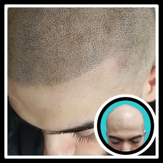 Clean lines and youthful vibes! 

#scalpmicropigmentation #smp #menshair #bald #hairlosssolution #ha