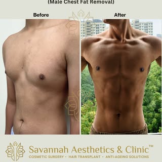 Male Chest Sculpting or Gynecomastia correction for our young client with a Grade 1 Gynecomastia all