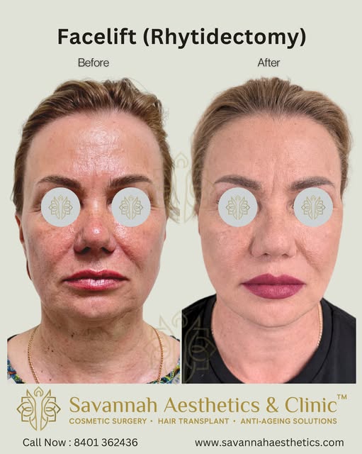 Our beautiful patient from Russia, who got a full face-rejuvenation done with us over the past coupl