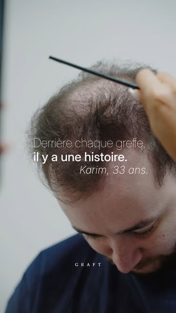 Découvrez le parcours de Karim, qui a choisi Graft pour retrouver une ligne frontale plus dense et u