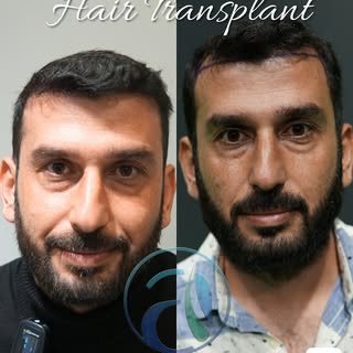 Before and after hair transplant | AKL Clinic 

Operation date: 03.07.2024
Total grafts: 4735

💬DM
