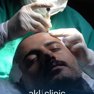 We are sharing with you a new hair transplant process performed at our clinic! 💥
We hope you enjoy 