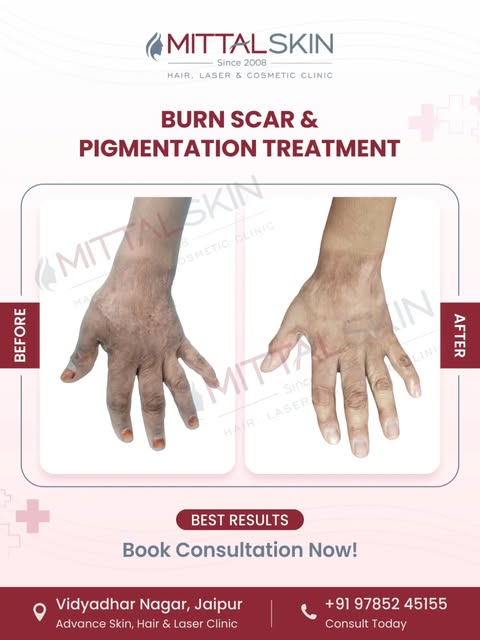 🔥 Burn scars can change more than your skin — they can affect your confidence too.

Burn injuries m