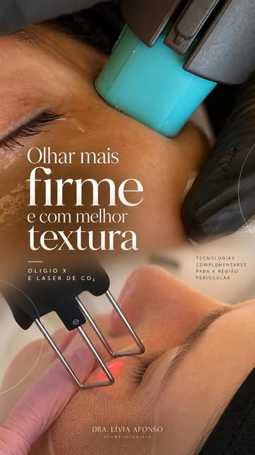 Pele fina, craquelada e com ruguinhas ao redor dos olhos?

A região periocular é uma das mais delica