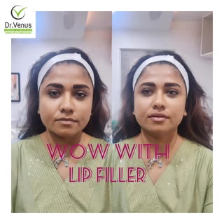 "✨ Stunning Transformation Alert! ✨

Check out the incredible results of Lip Filler treatment on our