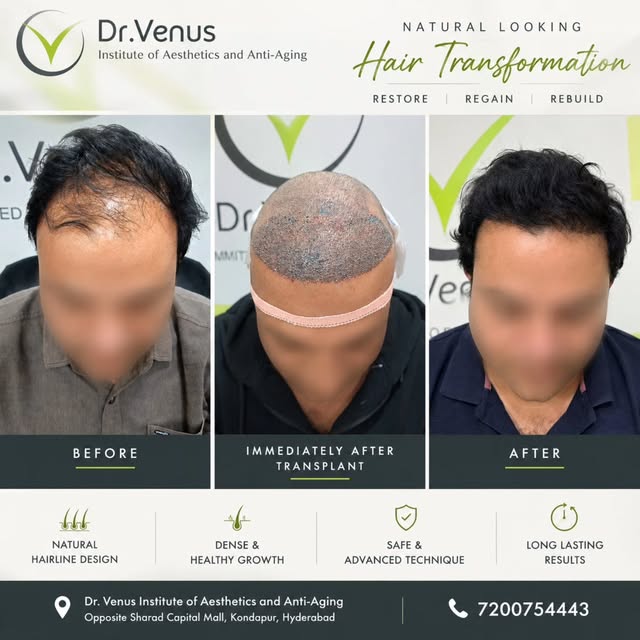 🌿 Hair Transplant Transformation | Natural. Designed. Restored

A receding hairline doesn’t have to