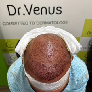 Post Hair Transplant Care 🧑‍⚕️🌱

A successful hair transplant doesn’t end when you leave the clini