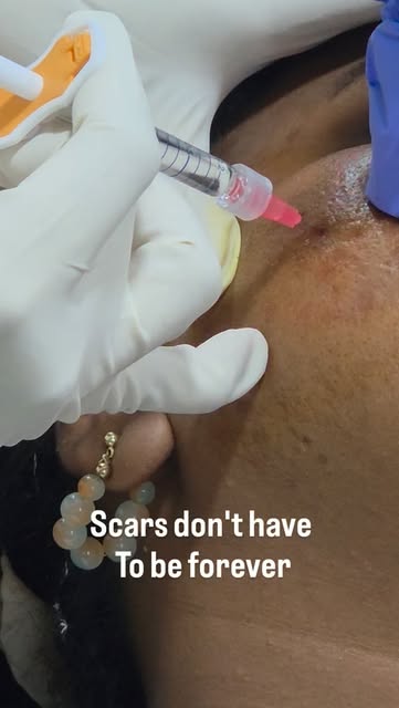 ✨ ACNE SCARS? LET’S WORK ON YOUR SKIN, NOT JUST COVER IT! ✨

Acne may fade, but the scars it leaves 