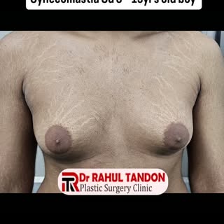 #drrahultandon #plasticsurgeon #prayagraj #preetihospital #gynecomastiatreatment Dr Rahul Tandon Pla