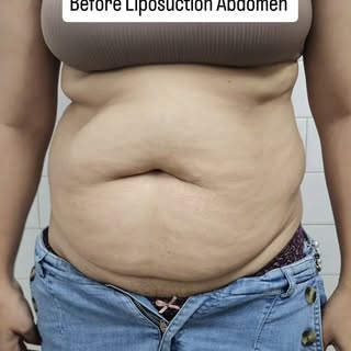 Liposuction Abdomen and Back in young mother #drrahultandon #plasticsurgeon #liposucción #prayagraj 