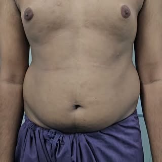 #drrahultandon #plasticsurgeon #prayagraj #cosmeticsurgery #gynecomastiatreatment