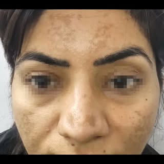 Rhinoplasty #drrahultandon #plasticsurgeon #prayagraj #rhinoplasty