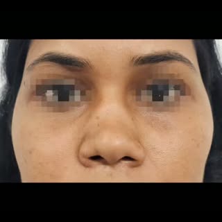 Post one month Augmentaion rhinoplasty ( Nose job ) Dr Rahul Tandon Plastic surgeon