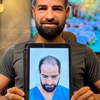 Resultado incrível após 6 meses de transplante capilar, e o melhor: ainda não chegamos ao resultado 