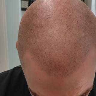 "It’s not whether you get knocked down, it’s whether you get up." – Vince Lombardi

Hair loss can kn