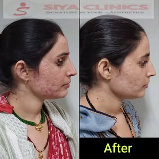 From Deep Scars to Smooth Confidence: The Science of Laser Scar Revision ✨

​Acne scars aren’t just 