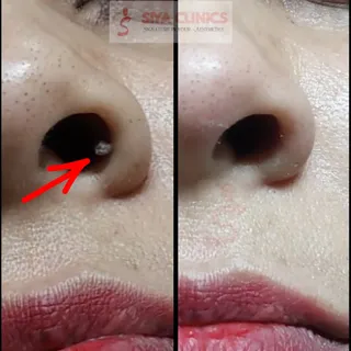 Hidden Discomfort, Solved in Minutes ✨

​Have you ever noticed a small, stubborn bump, skin tag, or 