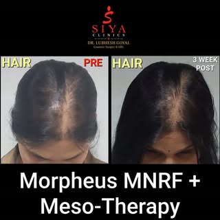 Visible Scalp Coverage in Just 3 Weeks! 🌿✨ The Power of Morpheus MNRF + Mesotherapy

​Hair thinning